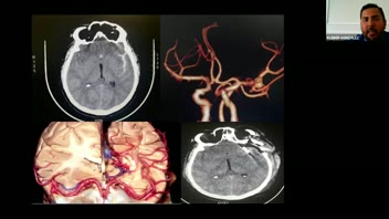 1st Latin American Neurosurgery Grand Rounds; MCA Aneurysms; Surgery; Part 1; Surgery;  Dr. Kléber Eduardo González Echiverria  of Ecuador; Dr. Joham Choque-Velasquez; Organizer.