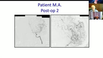 Management of Cerebral AVMs- >800 cases; Dr. Ghaus Malik; Part 2