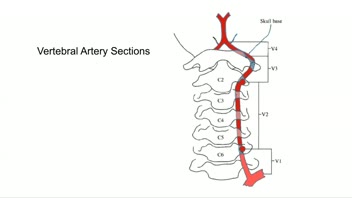 History of Cerebrovascular Disease Management;  James Ausman; Posterior Circulation Disease; VBI; cerebrovascular disease; surgery; Medical; Interventional; New treatments; Future
