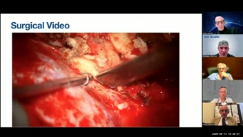 Management of Giant Vertebral Artery Aneurysm; Dr. Frank Hsu; UCIrvine